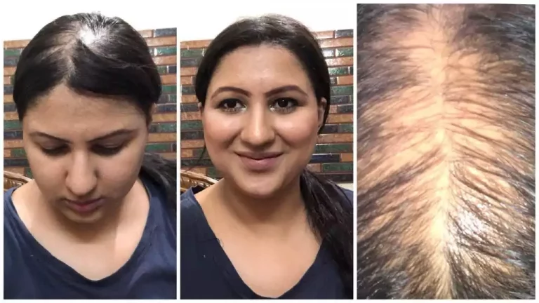 grow hair again naturally । गंजे सर पर बाल उगाने का घरेलू नुस्खा।